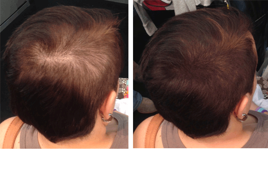 En 20 Segundos.                                     Consigue Cubrir Zonas Despobladas de Cabello con GORA Fibras Capilares