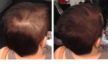 En 20 Segundos.                                     Consigue Cubrir Zonas Despobladas de Cabello con GORA Fibras Capilares