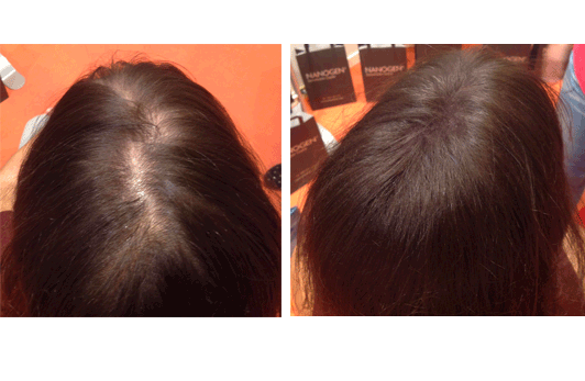 En 20 Segundos.                                     Consigue Cubrir Zonas Despobladas de Cabello con GORA Fibras Capilares