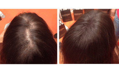 En 20 Segundos.                                     Consigue Cubrir Zonas Despobladas de Cabello con GORA Fibras Capilares